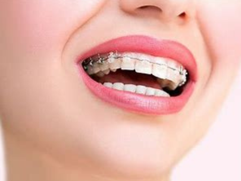 Niềng răng mắc cài sứ là gì? Ưu và nhược điểm mắc cài sứ