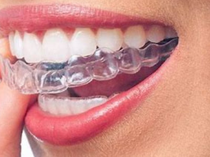 Niềng Răng Invisalign: Lựa Chọn Hoàn Hảo Cho Nụ Cười Đẹp Tự Tin