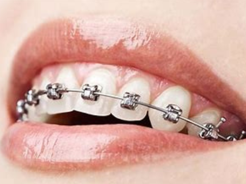Niềng răng mắc cài kim loại là gì? Quy trình và Phân loại