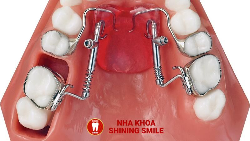 Tìm Hiểu Phương Pháp Niềng Răng Di Xa Toàn Hàm