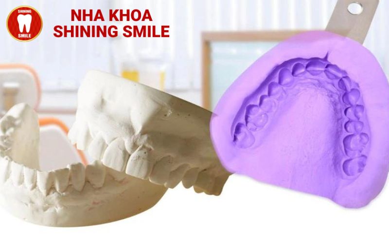 Lấy Dấu Răng Khi Niềng Để Làm Gì? Tìm Hiểu Ngay!