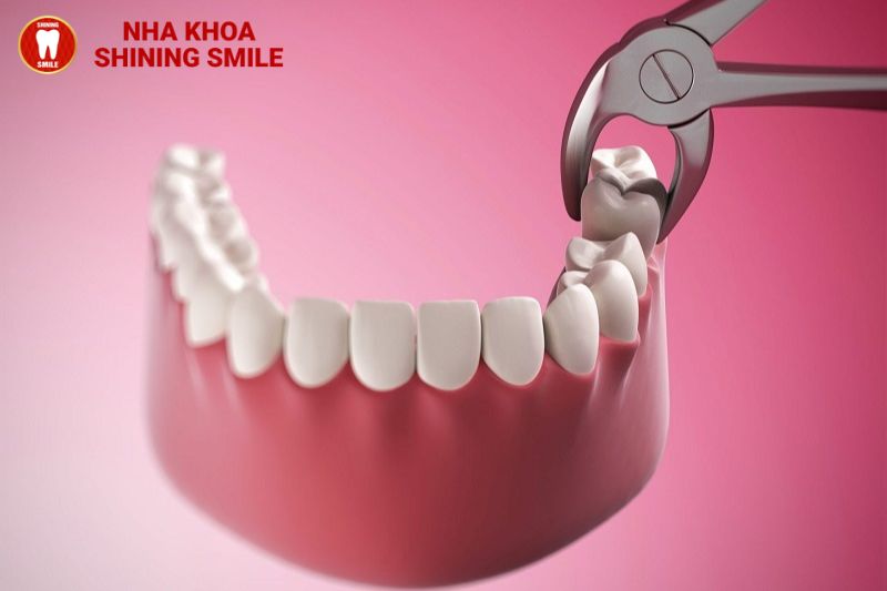 Niềng Răng và Nhổ Răng Số 8: Liệu Có Nguy Hiểm?