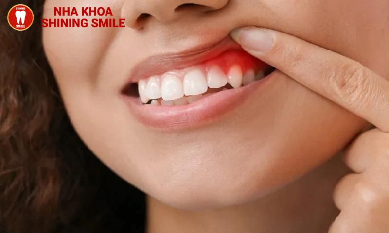 Niềng Răng Có Làm Răng Dài Ra Không? Giải Đáp Chi Tiết