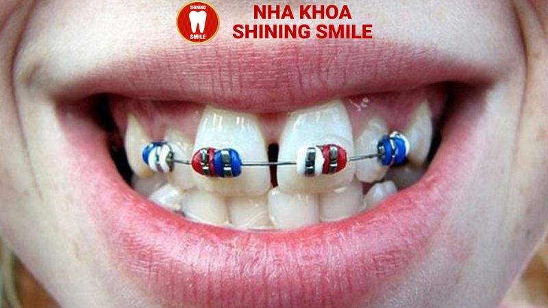 Niềng 4 Cái Răng: Giải Pháp Hiệu Quả Cho Vấn Đề Răng Miệng Cụ Thể