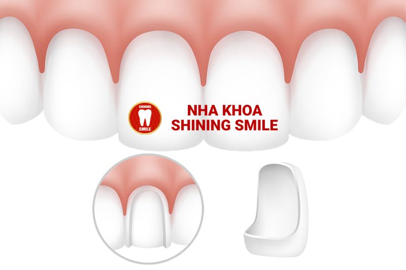 Bảng Giá Trồng Răng Sứ 2024: Cập Nhật Chi Tiết