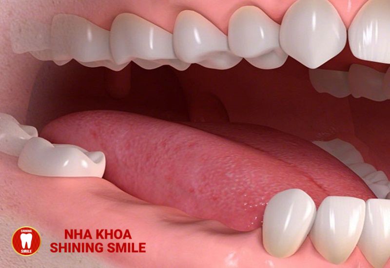 Khám Phá Trồng Răng Implant All On 4: Phương Pháp Hiệu Quả Cho Người Mất Nhiều Răng