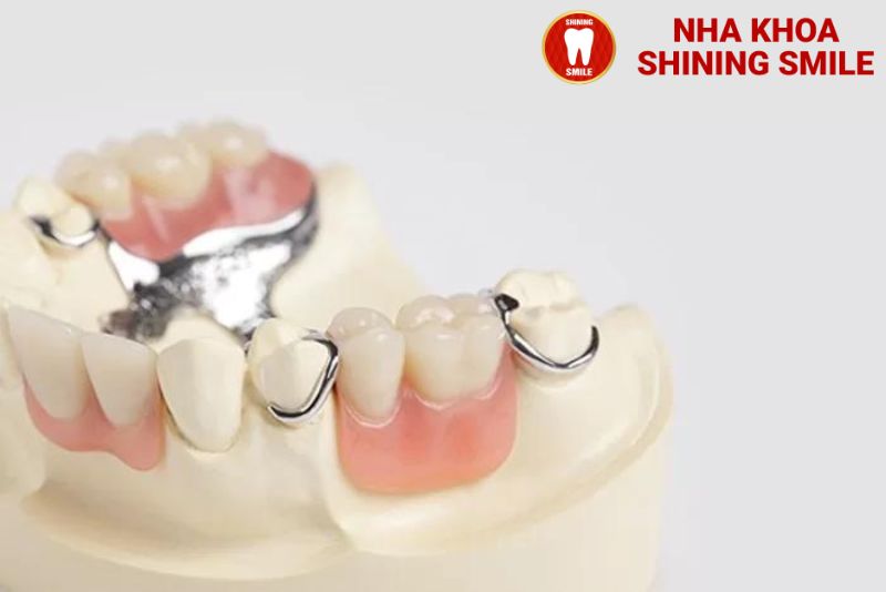 Trồng Răng Giả Bao Nhiêu Tiền? Tìm Hiểu Chi Phí Cụ Thể!