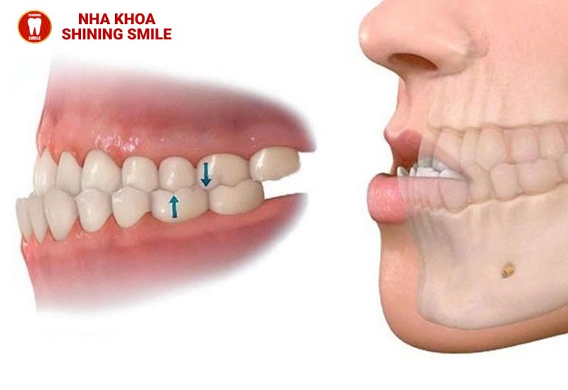 Niềng Răng Móm Có Hiệu Quả Không? Tất Cả Những Gì Bạn Cần Biết