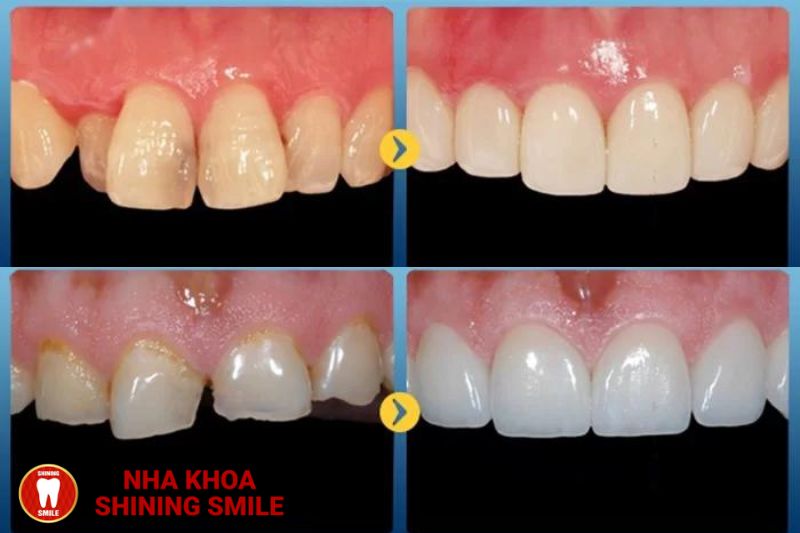 Có Thể Niềng Chỉ 1 Răng Được Không? Giải Đáp Thắc Mắc