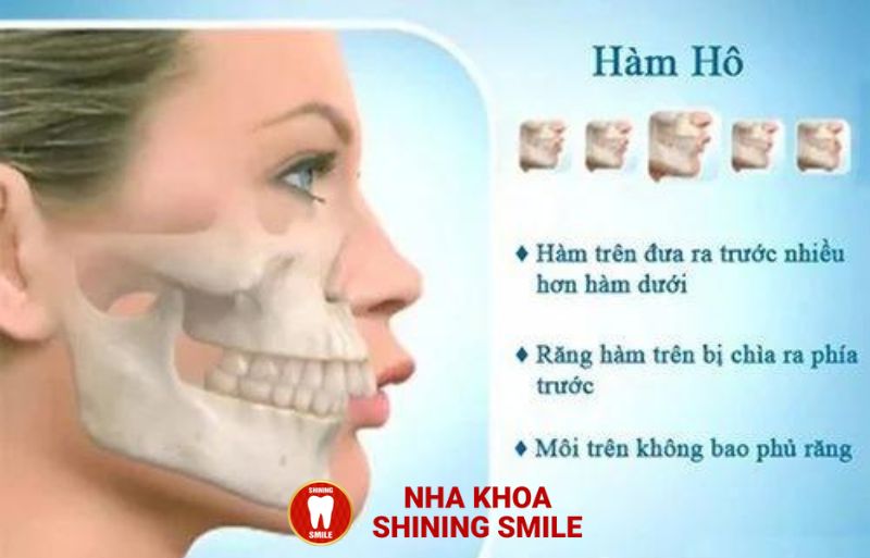 Niềng Răng Hô Nướu: Giải Pháp Tối Ưu Cho Nụ Cười Hoàn Hảo