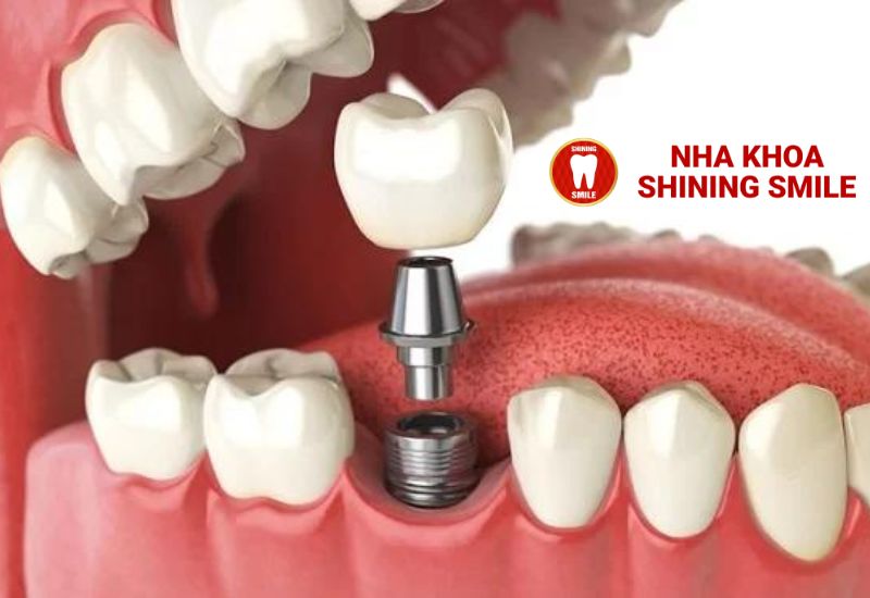 Giải Đáp Thắc Mắc: Trồng Răng Implant Có Đau Không?