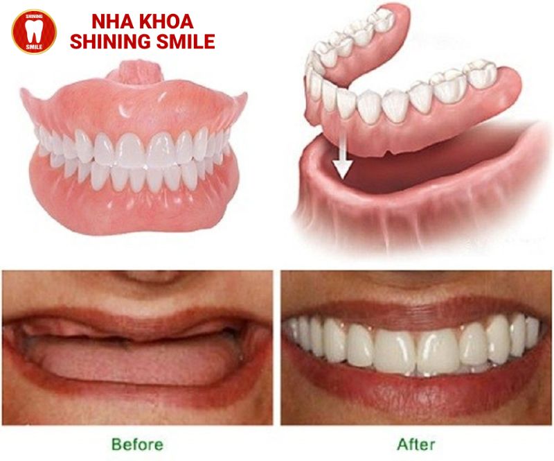 Lựa Chọn Phục Hình: Trồng Răng Tháo Lắp Có Thực Sự Hiệu Quả?