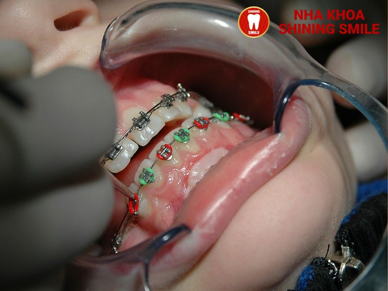 Hiệu Quả Tuyệt Vời Của Niềng Răng Ốc Nông Rộng: Tất Cả Những Gì Bạn Cần Biết