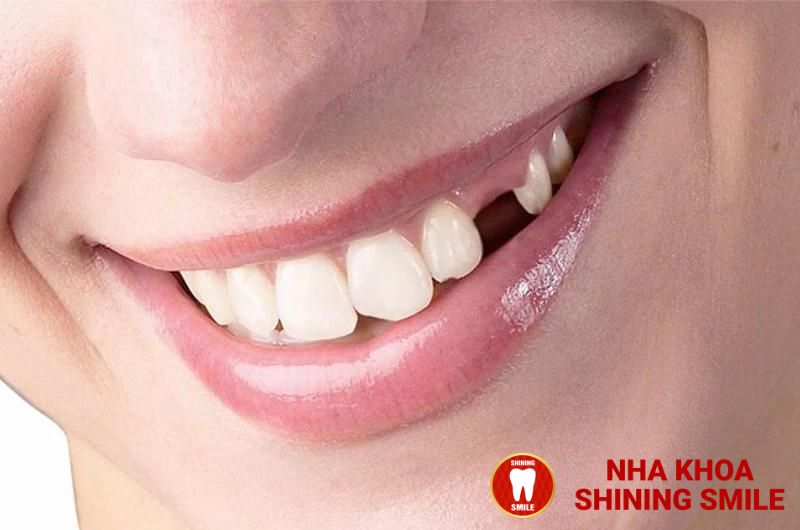 Mất Răng Số 3 Có Niềng Được Không? Nghe Chuyên Gia Tư Vấn