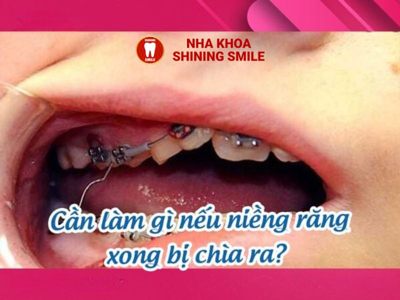 Khắc Phục Tình Trạng Niềng Răng Bị Chìa: Nguyên Nhân và Giải Pháp