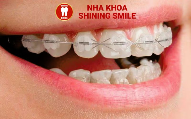 Niềng Răng Mắc Cài Sứ Có Đau Không? Giải Đáp Thắc Mắc