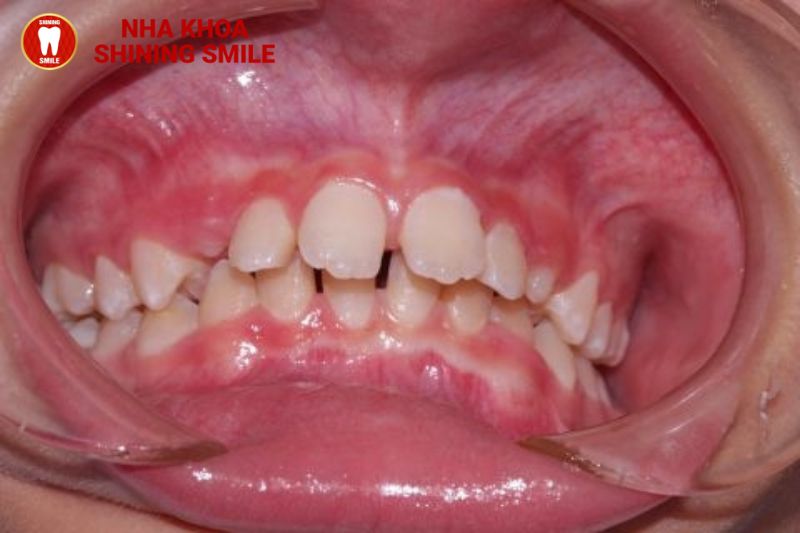 Giải Pháp Hiệu Quả Cho Niềng Răng Hô Cho Bé