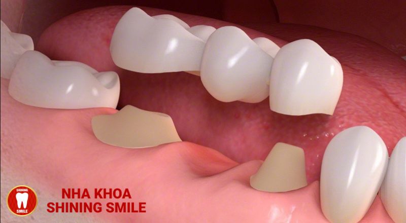 Chi Phí Trồng Răng Hàm Bị Sâu: Bạn Cần Biết Bao Nhiêu?