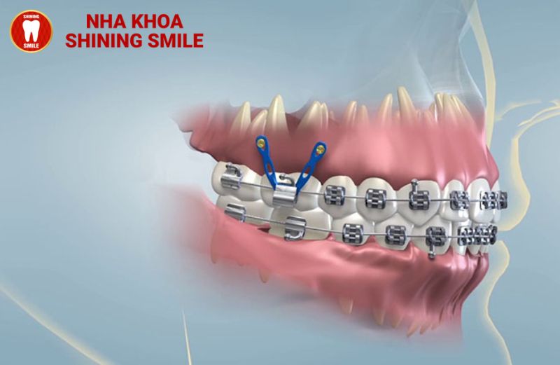 Giải Đáp Thắc Mắc: Cắm Vít Niềng Răng Có Đau Không?