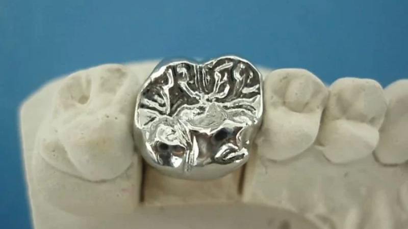 Bọc Răng Inox Giá Bao Nhiêu? Thông Tin Chi Tiết