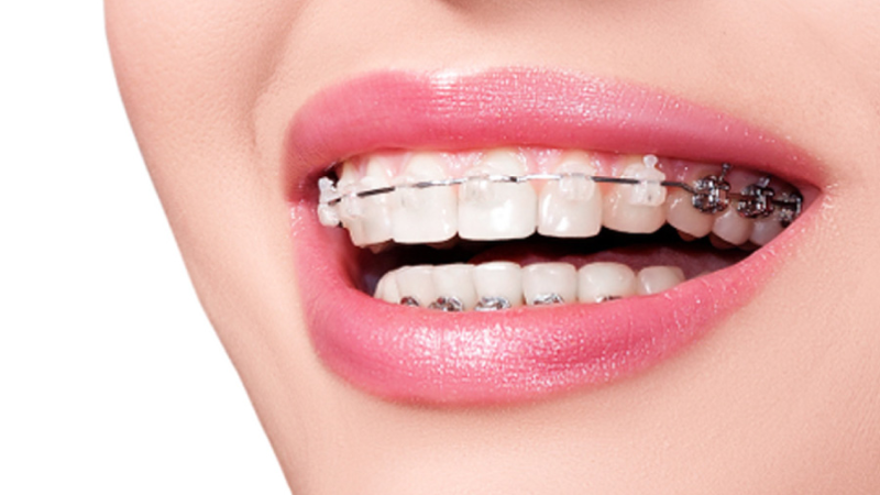 Bọc Răng Sứ Có Niềng Răng Được Không? Giải Đáp Thắc Mắc