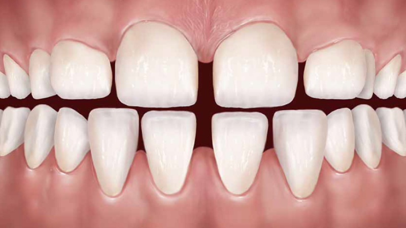 Bọc Răng Thưa Bao Nhiêu Tiền? Bảng Giá Mới Nhất