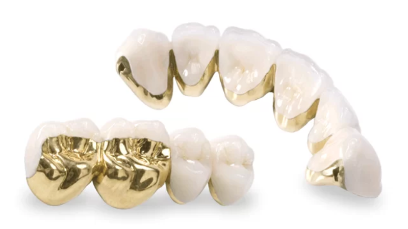 Bọc Sứ Răng Cấm Bao Nhiêu Tiền? Thông Tin Giá Cả