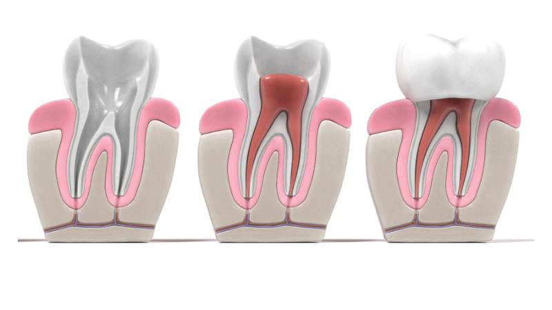Bọc Sứ Cho Răng Cửa Bị Sâu: Giải Pháp Hiệu Quả