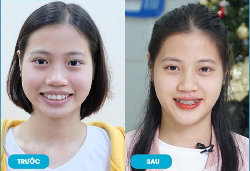 Lột Xác Ngoạn Mục Sau Khi Niềng Răng: Hành Trình Và Kết Quả
