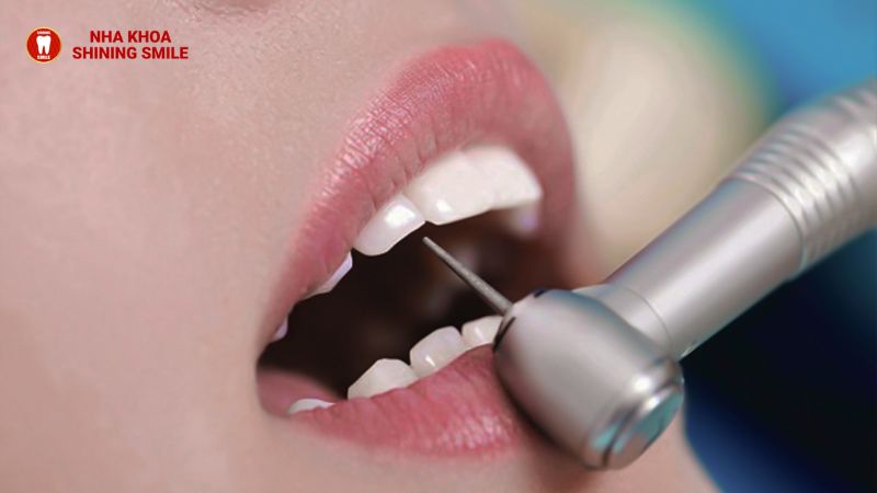 Hình Ảnh Răng Sau Khi Mài: Trải Nghiệm Thực Tế