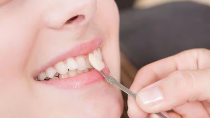 Răng Cửa Nên Bọc Sứ Loại Nào? Tư Vấn Lựa Chọn