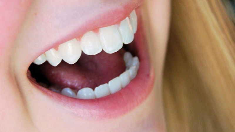 Răng Sứ Cercon Của Nước Nào? Chất Lượng Ra Sao?