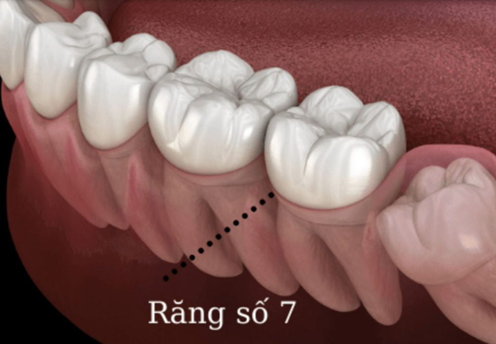 Niềng Răng Có Thể Áp Dụng Cho Người Mất Răng Số 7 Hàm Dưới Không?