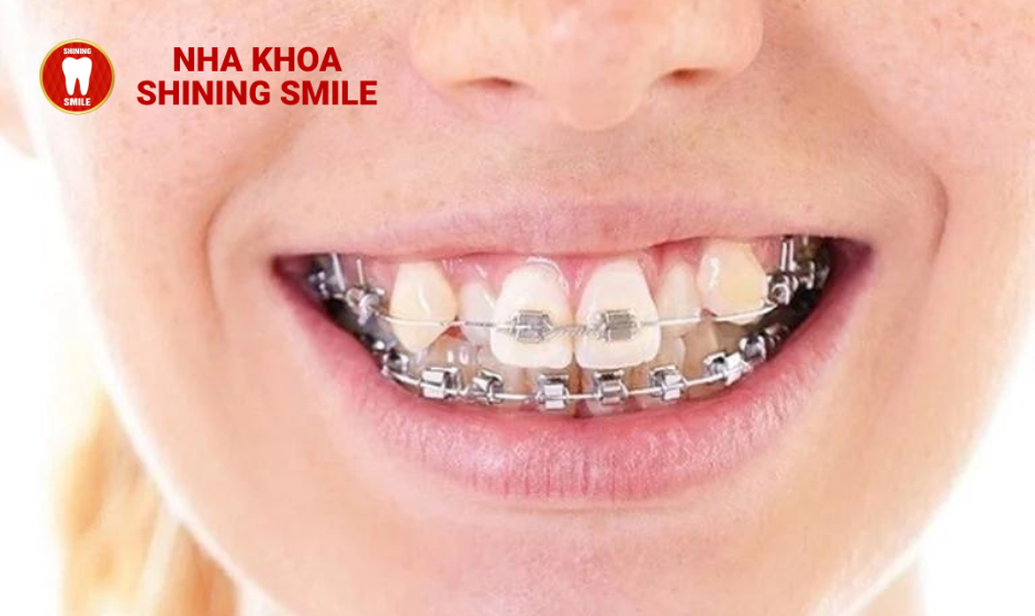 Chi Phí Niềng Răng Khểnh: Bảng Giá và Lựa Chọn Phù Hợp