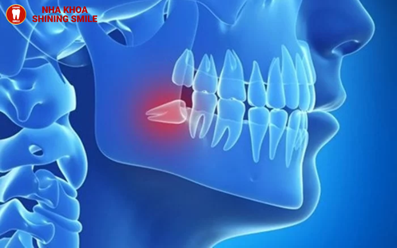 Trồng Răng Số 8: Có Nên Thực Hiện? Chuyên Gia Tư Vấn!