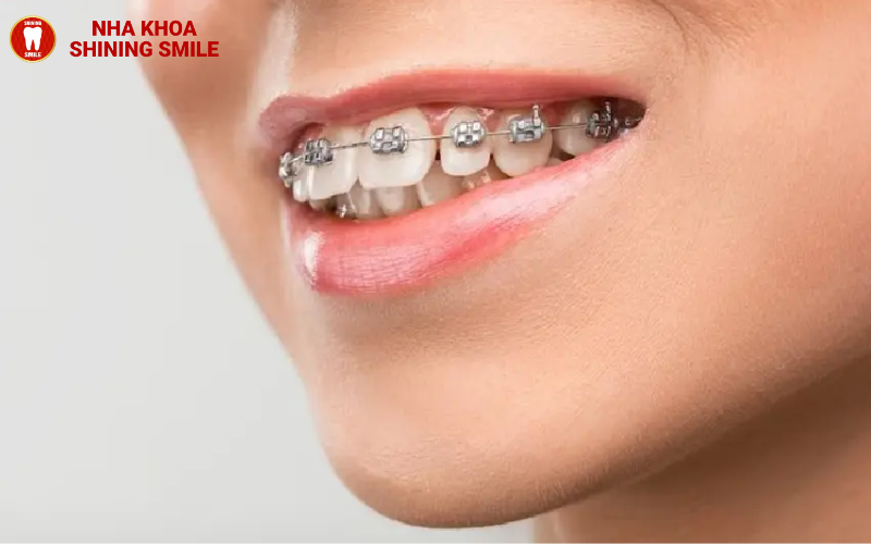 Giá Niềng Răng Thưa Hàm Trên: Thông Tin Chi Tiết Và Lựa Chọn!