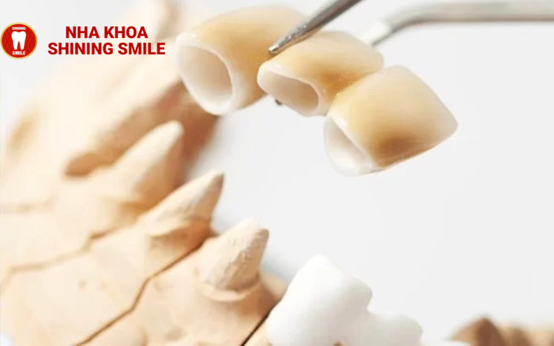 Trồng Răng Sứ Mất Bao Lâu Thời Gian? Tìm Hiểu Ngay!