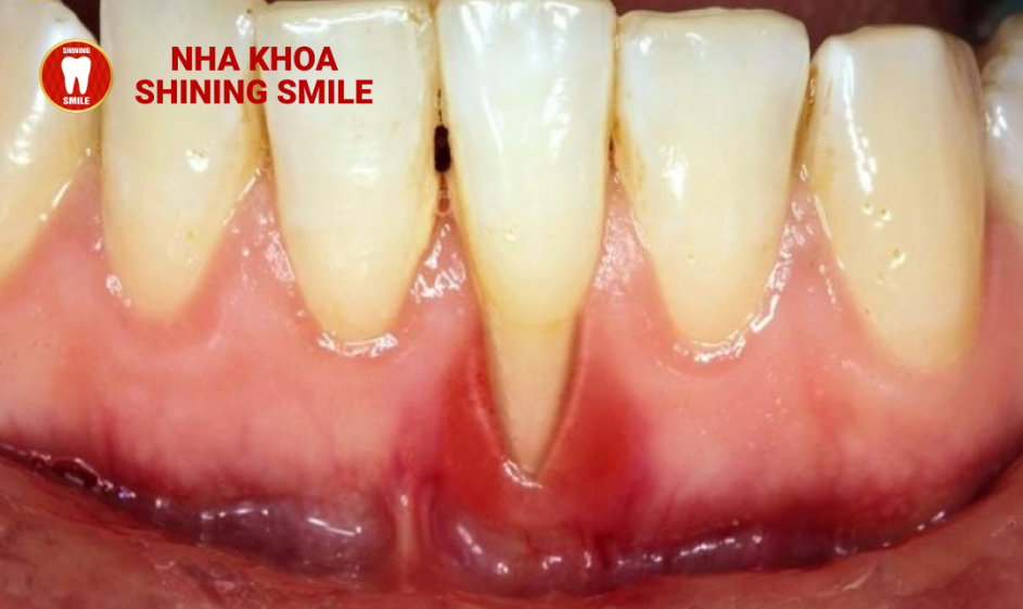 Niềng Răng Bị Sưng Lợi: Nguyên Nhân và Cách Xử Lý Hiệu Quả