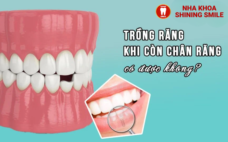 Còn Chân Răng Có Trồng Răng Được Không? Giải Pháp Tốt Nhất!