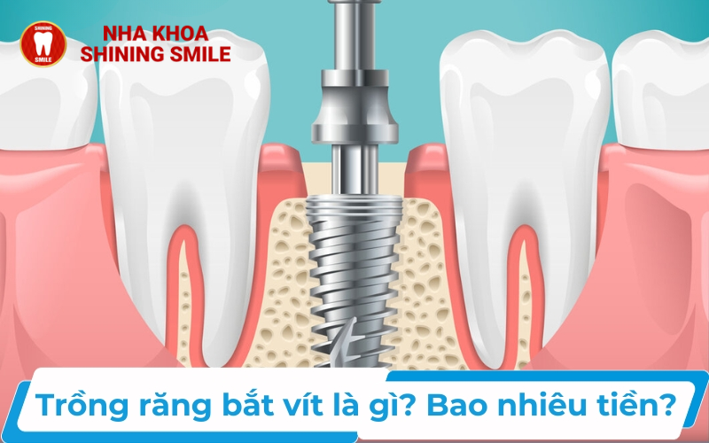 Trồng Răng Bắt Vít Giá Bao Nhiêu? Bảng Giá Mới Nhất!