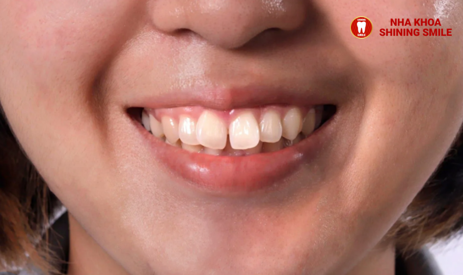 Quy Trình Niềng Răng Hô Chi Tiết Từ A Đến Z