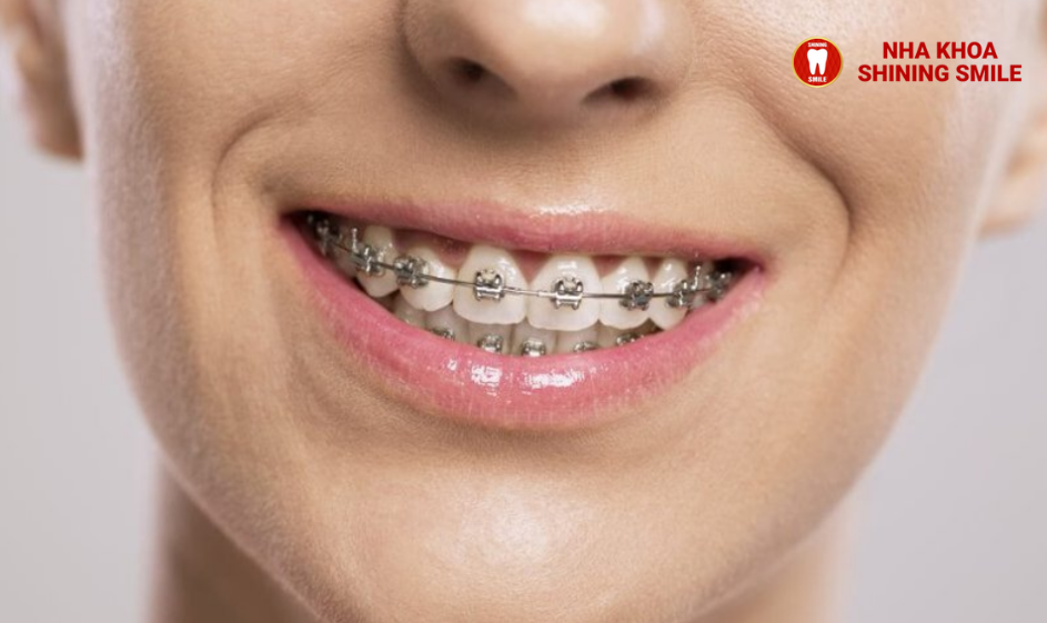 Niềng Răng Bị Đau Chân Răng: Nguyên Nhân và Giải Pháp Giảm Đau