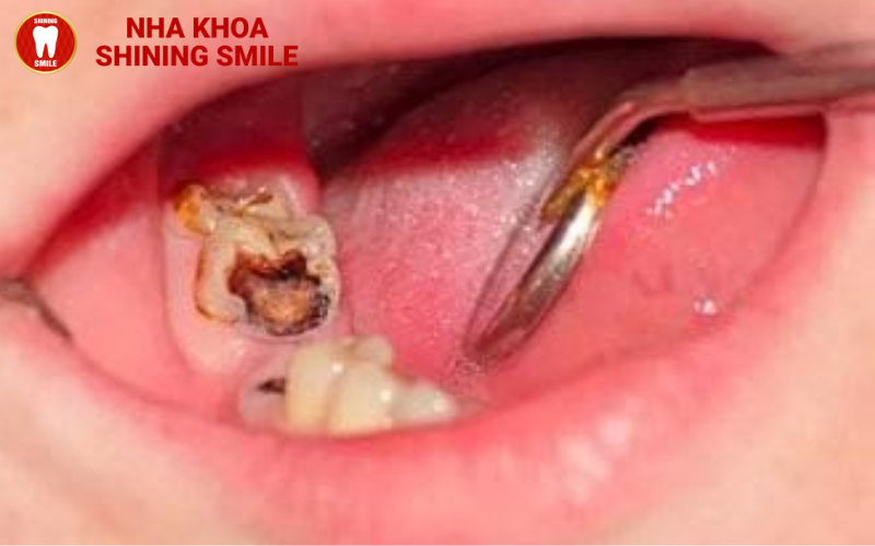 16 Tuổi Trồng Răng Được Không? Lời Khuyên Từ Bác Sĩ!