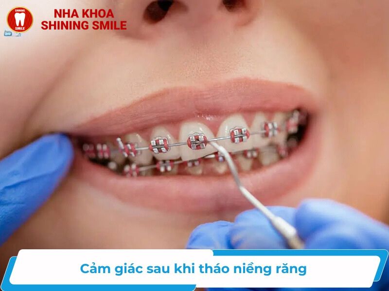 Khám Phá Cảm Giác Sau Khi Tháo Niềng Răng