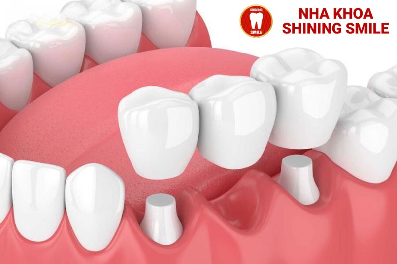 Bắc Cầu Răng Sứ - Giải Pháp Nhanh Chóng Cho Nụ Cười Hoàn Hảo