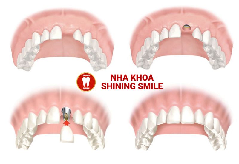Khám Phá Chi Phí Trồng Răng Cửa - Giải Pháp Hoàn Hảo Cho Nụ Cười