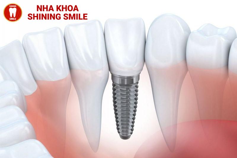 Nhược Điểm Của Trồng Răng Implant - Những Điều Cần Biết Trước Khi Quyết Định