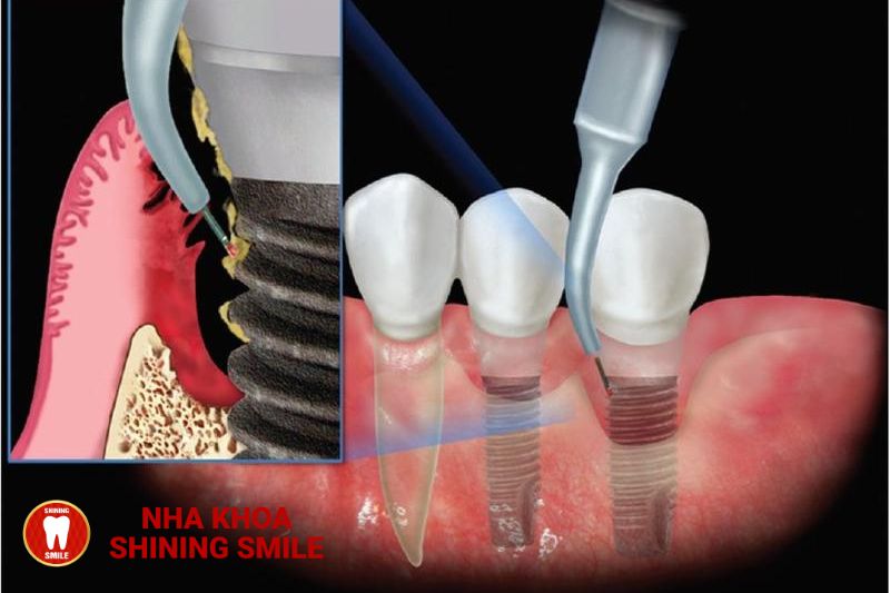 Tác Hại Của Việc Trồng Răng Implant - Những Điều Bạn Cần Biết