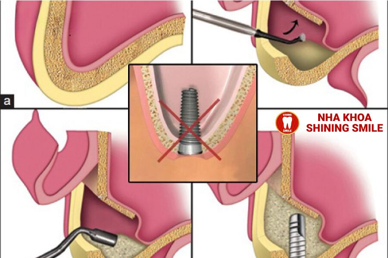 Thời Gian Trồng Răng Implant - Bạn Cần Biết Bao Lâu Để Có Nụ Cười Hoàn Hảo?