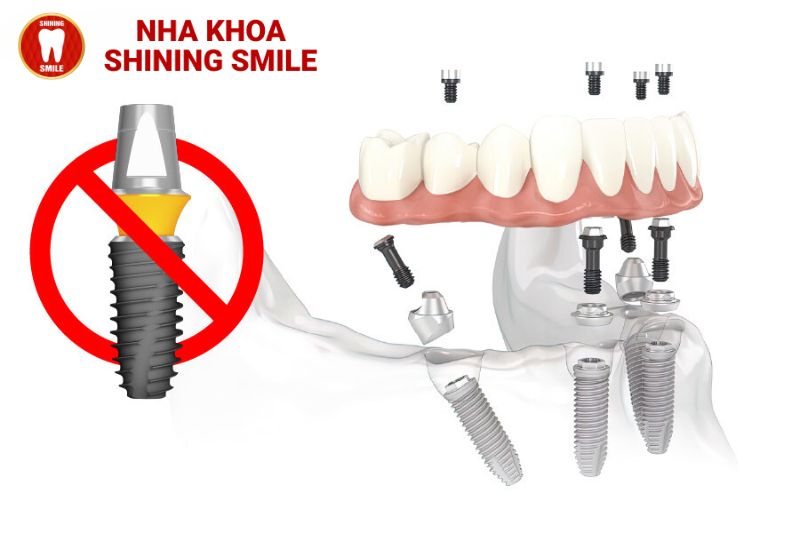 Top 3 Trụ Implant Hàn Quốc Đáng Chú Ý Cho Nụ Cười Hoàn Hảo